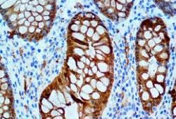 Advancement of Galectin-3 Inhibitors Is Being Pursued