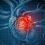 Chronic Coronary Artery Disease Market Trend, Analysis, Future Growth, Industry Trend, Forecast Period 2020-2026 |Top Key Players: Gilead, AstraZeneca, Lupine Pharmaceuticals Inc., Novartis, Abbott Vascular