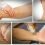Diabetic Peripheral Neuropathy Treatment Market By Top Key Players Achelios Therapeutics Inc, Celgene Corp, Commence Bio Inc