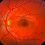 Huge Growth for Diabetic Macular Edema Drug Market during 2020-2027 Profiling Key Players GNT Pharma, Synthetic Biologics, Avicena, Amkor Pharma, Mitsubishi Tanabe Pharma, Sanofi, Biogen, Apotex
