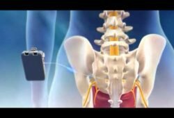 Sacral Nerve Stimulators