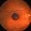 Profitable Strategic Report on Retinal Disorder Treatment Market Detail Analysis by 2020-2027 Focusing on Top Key Players NOVARTIS AG, SANTEN PHARMACEUTICAL CO., LTD., REGENERON, GRAYBUG VISION, INC